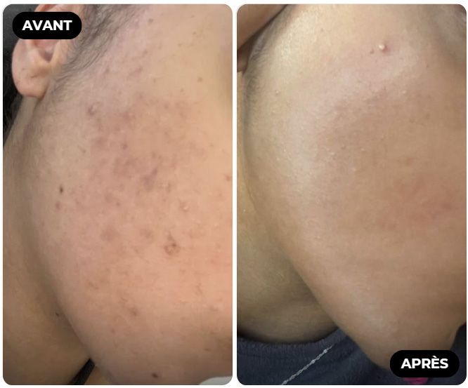 Résultat Avant Après