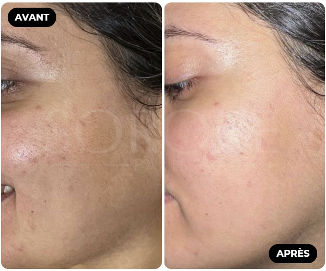 Résultat Avant Après