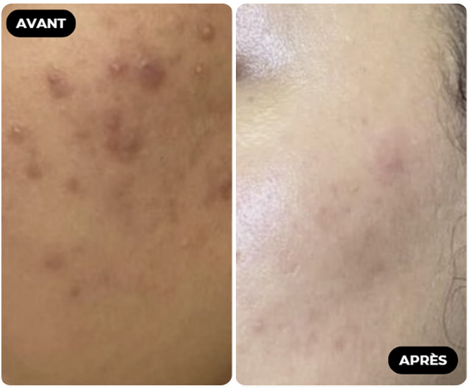 Résultat Avant Après
