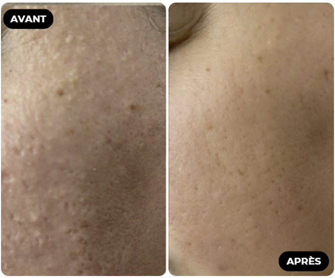 Résultat Avant Après