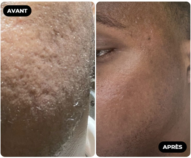 Résultat Avant Après