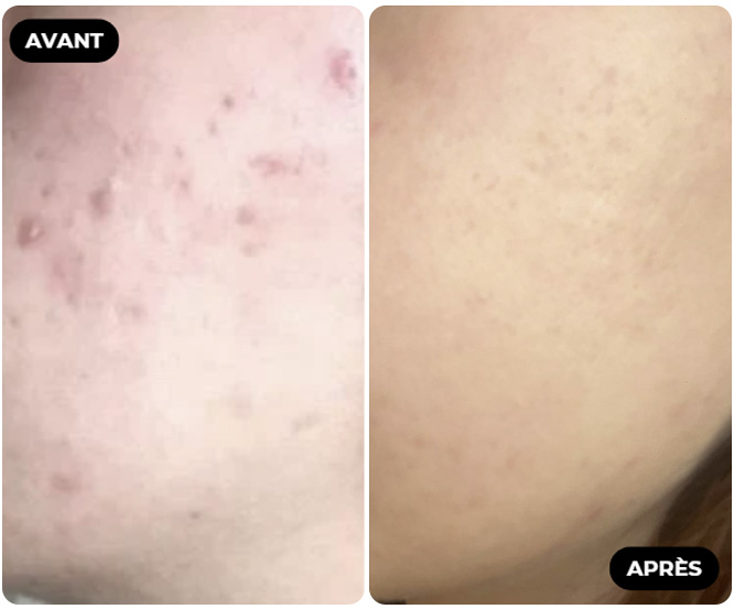 Résultat Avant Après