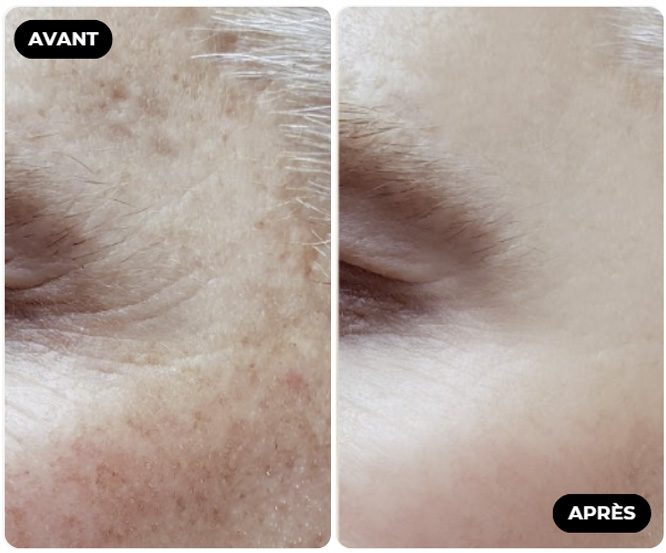 Résultat Avant Après