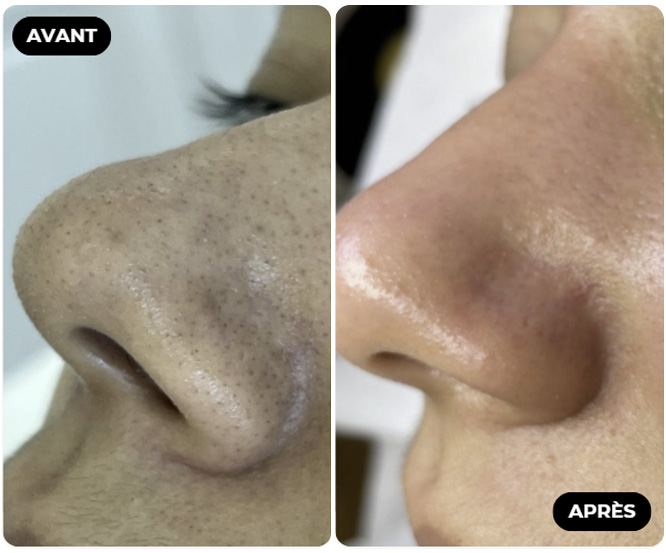 Résultat Avant Après